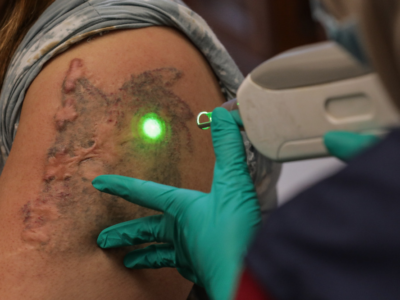 Baznas DKI Kembali Gelar Program Hapus Tato Gratis